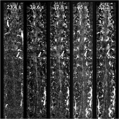 Feasibility of Noninvasive Diagnosis of Spinal Vascular Diseases Using Time-Resolved Angiography With Stochastic Trajectories